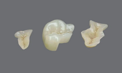 二氧化锆切削嵌体